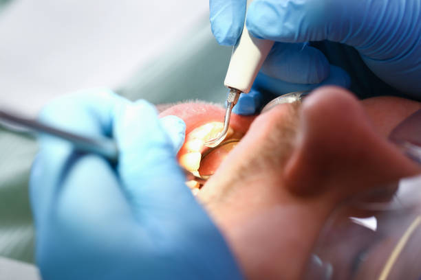 Best Emergency Dental Care for Broken or Chipped Teeth in Wolf Lake, MI